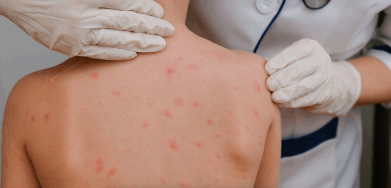 Sarampión: ya son 26 los casos confirmados en el país, uno en San Luis